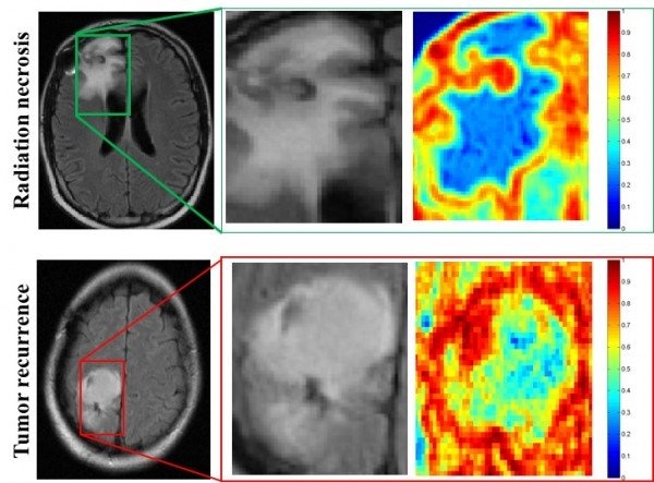 MRI scans of patients with radiation necrosis (above) and cancer recurrence...