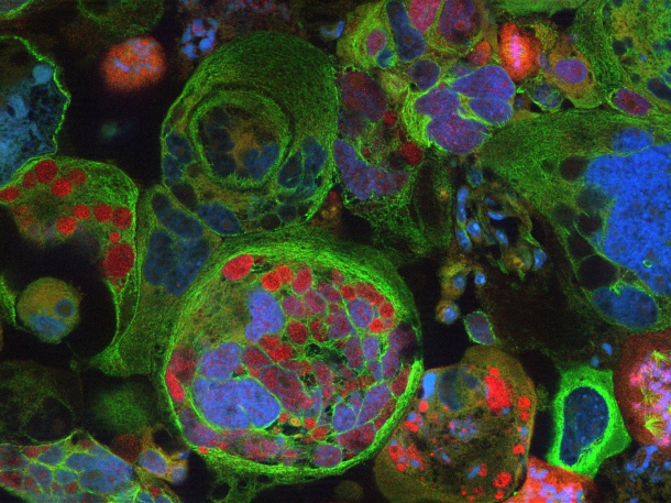 Blick durchs Mikroskop: Der rote Farbstoff ist ein spezieller Tumorzell-Marker,...