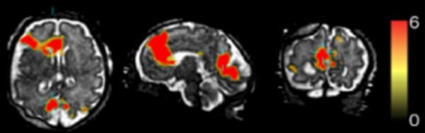 Functional MRI of a fetal brain, showing activated regions (red) of the default...