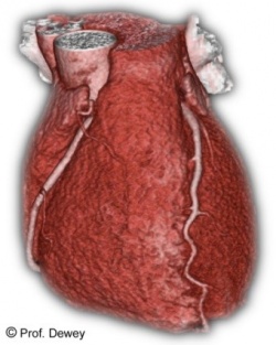 3D CT showing normal coronary arteries.