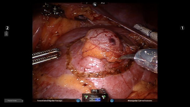 Normal 3-D HD illumination mode (view of renal hilum) during da Vinci partial...