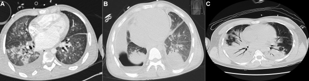 CT-Aufnahmen der berichteten Fälle von Hydrocarbonpneumonitis bei drei...