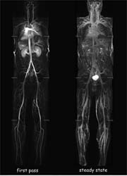 Detailed MR images of arteries and veins obtained with Vasovist 