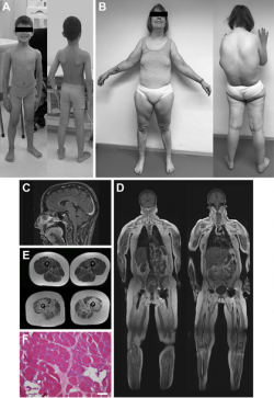 Clinical, Imaging, and Muscle Biopsy Findings of Individuals with Bi-allelic...