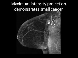 Photo: Mammography screening with MR