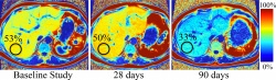 Axial quantitative MR images in the abdomen of a 39-year-old man with...