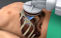 Doctors wish to use focused ultrasound to treat tumors in moving organs, such...