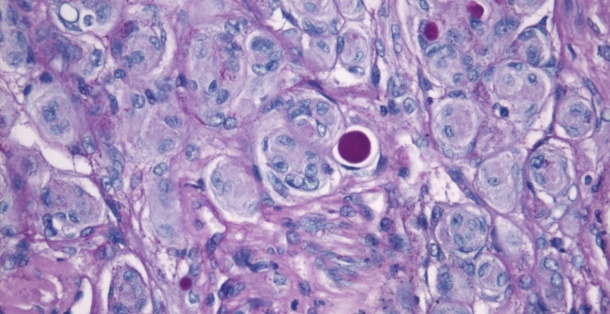 Hirntumor-Zellen (Meningeom-Zellen) unter dem Mikroskop.