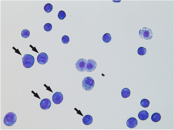 AML1-ETO führt zu Blasten (Pfeile), unreifen Blutzellen der „myeloischen“...