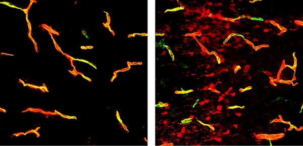 Normal brain blood vessels completely contain a fluorescent dye (left). Vessels...