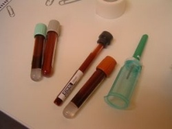 Photo: A simple blood test may reduce mortality in heart failure patients