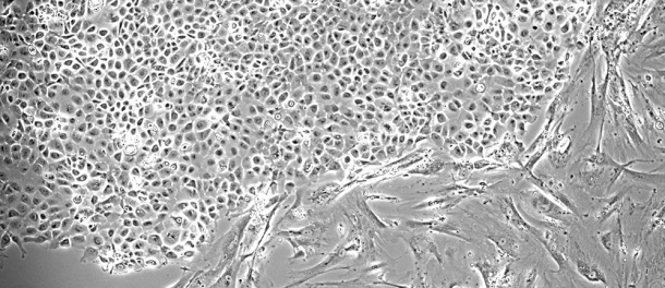 Das Bild zeigt isolierte Zellen aus einem Pleuraerguss. Die Krebszellen unten...