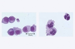 AML-Zellen vor (links) und nach kombinierter, epigenetisch wirksamer Behandlung.