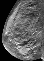 Reconstructed tomosynthesis slice of the same breast showing a tumour that is...