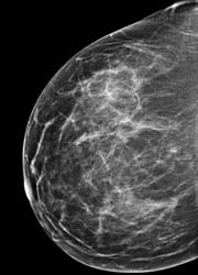 Weve completed 300 cases 
to date using breast tomosynthesis. In two of the...