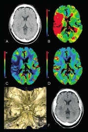 Figure 1: CT stroke imaging 50-year-old patient. Several TIAs already on day of...