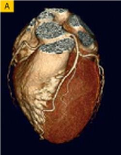 Fig. 1 - MSCT : (A) Normal coronary artery