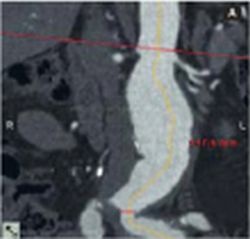 Fig. 1: Preoperative imaging of aortic aneurysm for planned endograft...