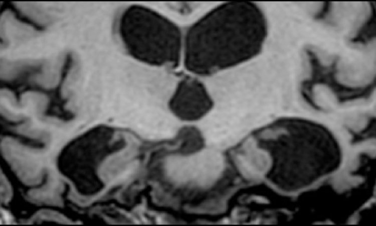 Dementia – MRI is the first step in diagnosis • healthcare-in-europe.com