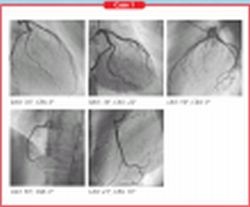 Coronary study, normal patient. Sex: Male Age: 59 years old Weight: 64 kg...