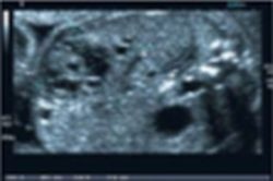Fig. 1: Fetal giant haemangioendothelioma, initial diagnosis, B-mode