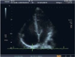 Noticeable dilatation of the right-sided heart cavities with pulmonary-arterial...