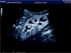 Photo: Contrast agents in Sonography