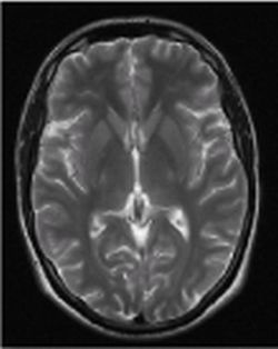 Fig. 2: MRI of the skull with unremarkable depiction of the cerebral parenchyma