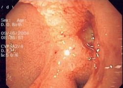 Photo: Increasing incidence of adenocarcinoma of the esophagus