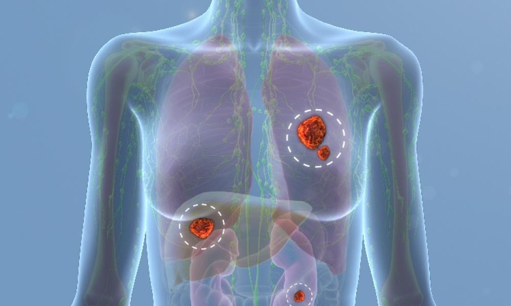 Collaboration on early detection of recurrent breast cancer •