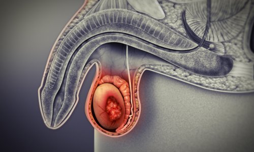 Hodenkrebs-Screening: Derzeit keine Empfehlung