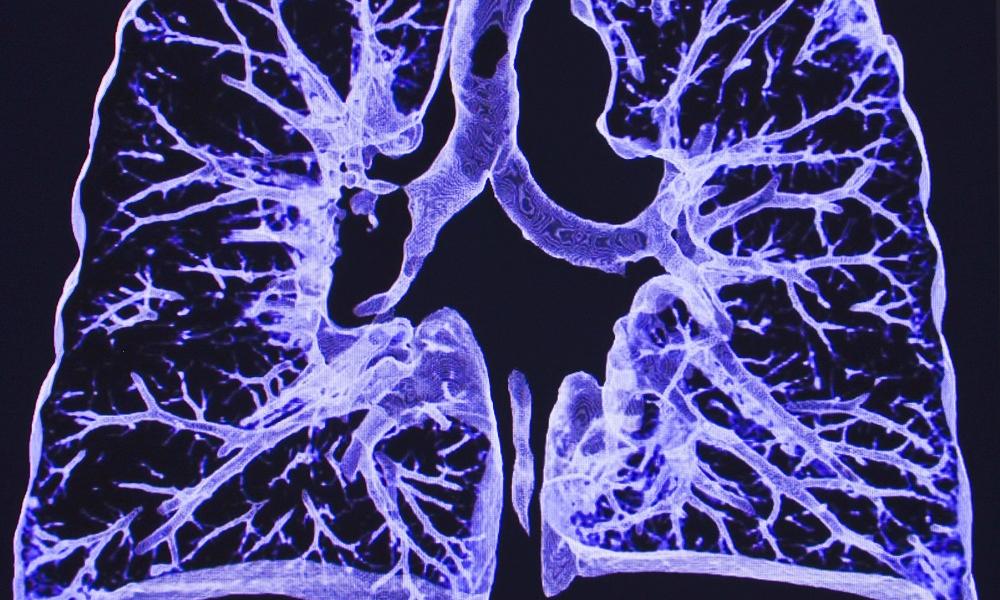 CT outperforms lab diagnosis for coronavirus infection • healthcare-in ...