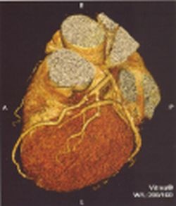 Fig. 2: 3D heart reconstruction with coronary arteries