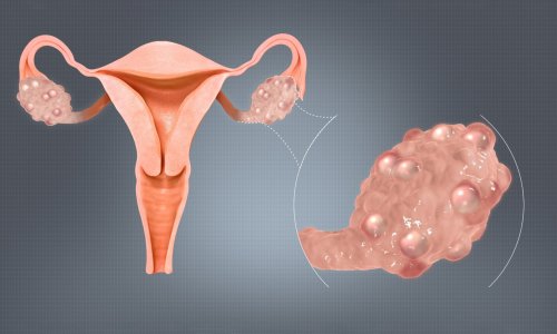 Better treatment for women with PCOS