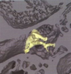 Fig. 4: 3D petrous bone reconstruction