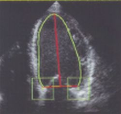 Fig. 2: The ventricular contour is fit between the marked reference points...