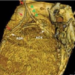 Fig. 3: Y graft of mammary arteries anastomosed on ADA and ACX (3D VR...