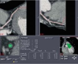 Fig. 2: Vascular assessment by the software on any vascular segment of interest