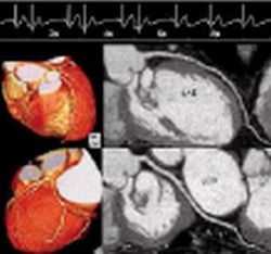 Fig. 4: Coronary artery reconstruction with a change in heart frequency from 43...
