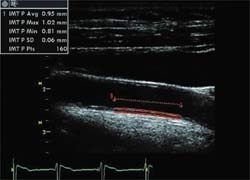 Photo: A non-invasive measurement of arterial wall atherosclerosis