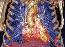 Photo: CTA benefits coronary artery bypass graft patients