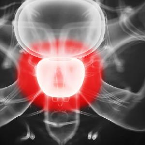 Finding biomarkers for aggressive prostate cancer • healthcare-in ...