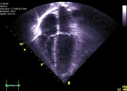 Photo: Imagify™- first imaging agent to assess myocardial perfusion using...