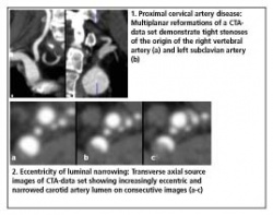 Photo: Carotid artery disease