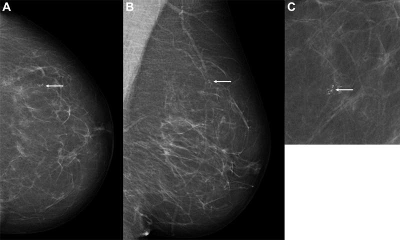 The Value Of AI In Breast Screening • Healthcare-in-europe.com