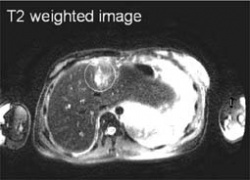 Liver tumour: Image from University Hospital Muenster that demonstrates the...