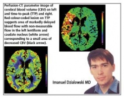 Photo: Computed tomography and acute stroke