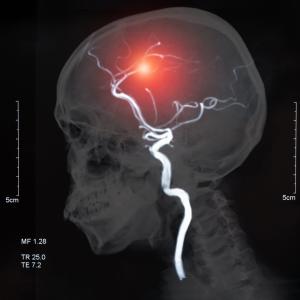 Ultra-high-res MRI Reveals How Migraine Changes The Brain • Healthcare ...