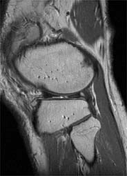 In this sagittal MR image a small radial tear of the meniscus is clearly seen...