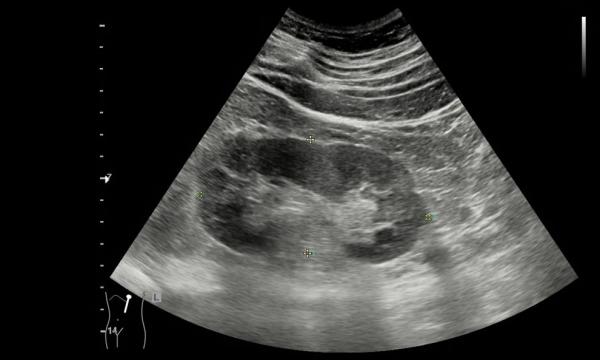 Point of Care Ultrasound Technology (POCUS) With AI